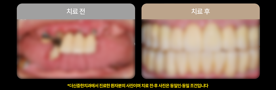 더신중한치과 전후사진