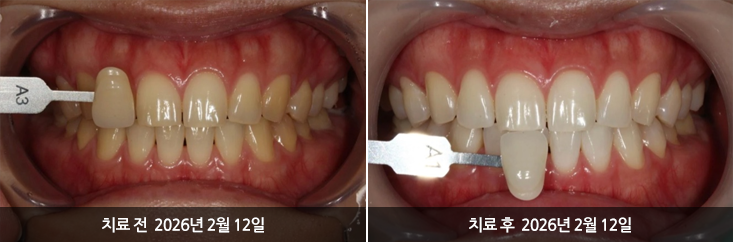 더신중한치과 전후사진