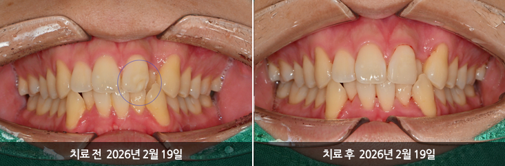 더신중한치과 전후사진