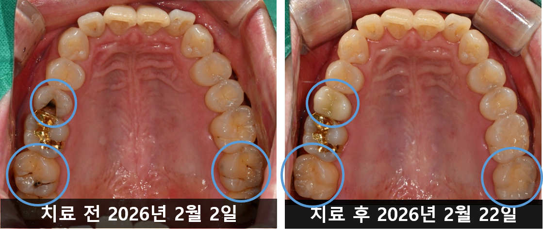 더신중한치과 전후사진